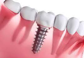 Dental Implants: What They Are, Types of Dental Implants, and Affordability