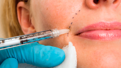The Cosmetic Revolution of Dermal Filler’s: Significant Benefits